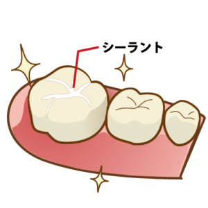 予防 シーラントについて 豊田市の歯医者ならつづき歯科へ