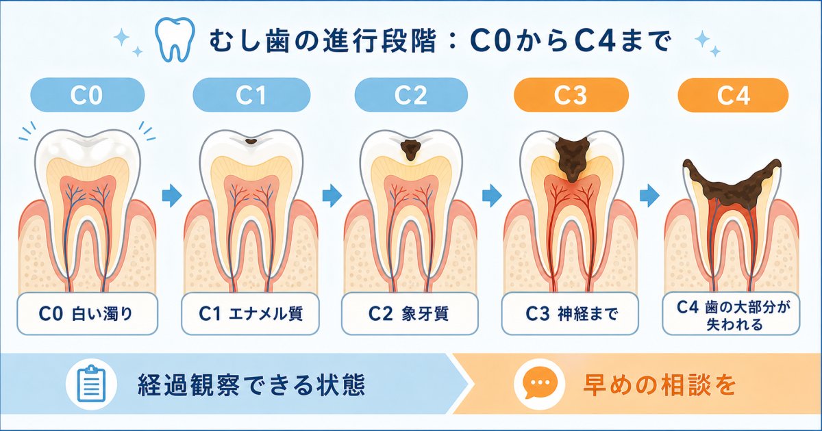 「生え変わるから放置しても大丈夫」は誤解?乳歯のむし歯リスクと永久歯への影響
